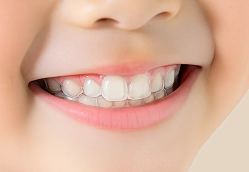 インビザライン・ファーストを装着した子どもの歯の写真
