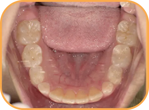 治療後下顎からの歯の様子