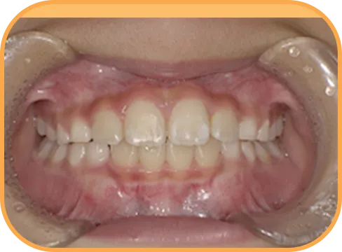 治療後正面からの歯の様子