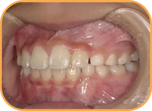 治療後左側からの歯の様子