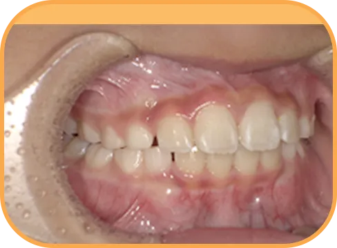 治療後右側からの歯の様子