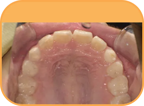 治療後上顎からの歯の様子