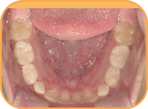 治療後下顎からの歯の様子
