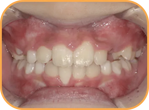 治療後正面からの歯の様子