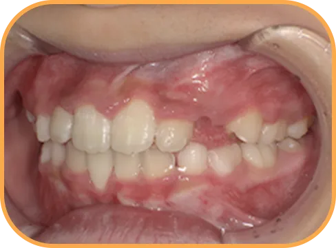 治療後左側からの歯の様子