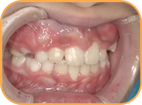 治療後右側からの歯の様子