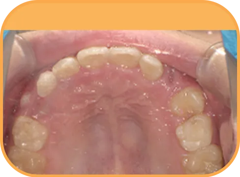 治療後上顎からの歯の様子