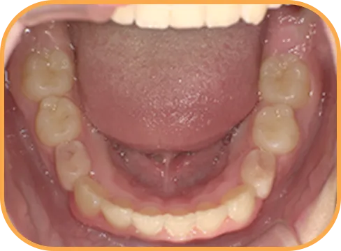 治療後下顎からの歯の様子