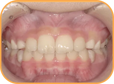 治療後正面からの歯の様子