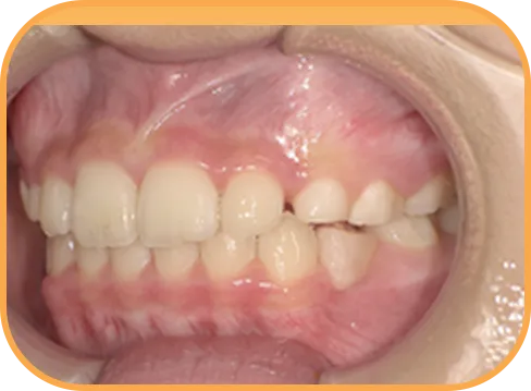 治療後左側からの歯の様子