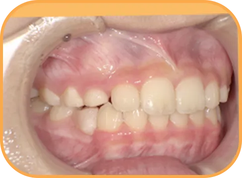 治療後右側からの歯の様子