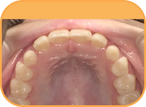 治療後上顎からの歯の様子
