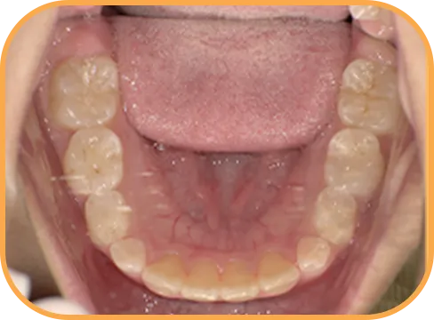 治療後下顎からの歯の様子