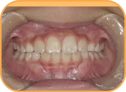 治療後正面からの歯の様子
