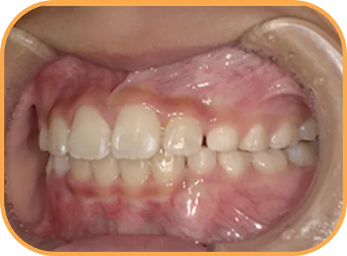 治療後左側からの歯の様子