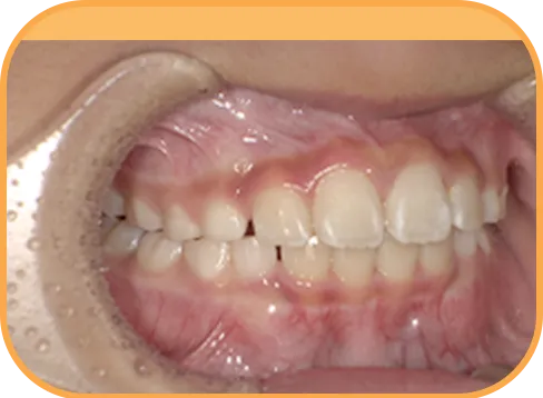 治療後右側からの歯の様子