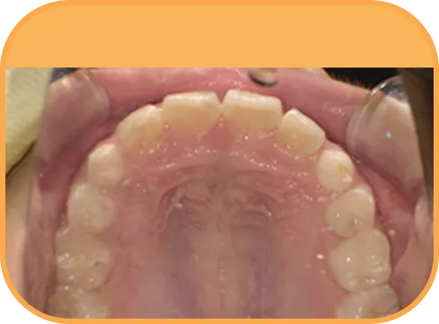 治療後上顎からの歯の様子