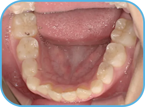 治療前下顎からの歯の様子
