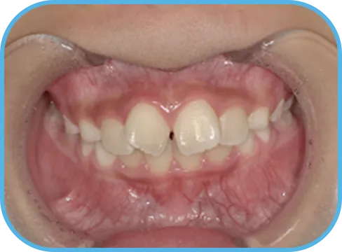 治療前正面からの歯の様子