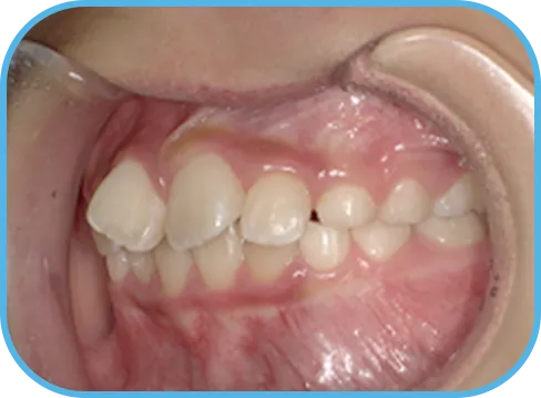 治療前左側からの歯の様子