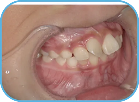 治療前右側からの歯の様子