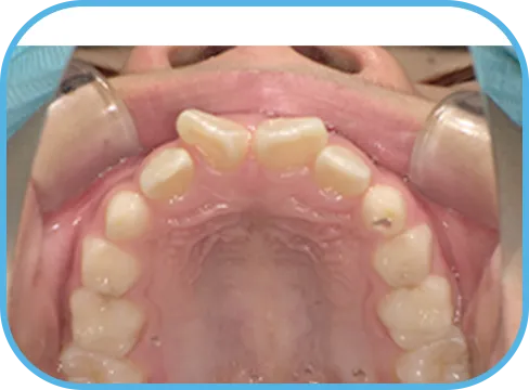 治療前上顎からの歯の様子