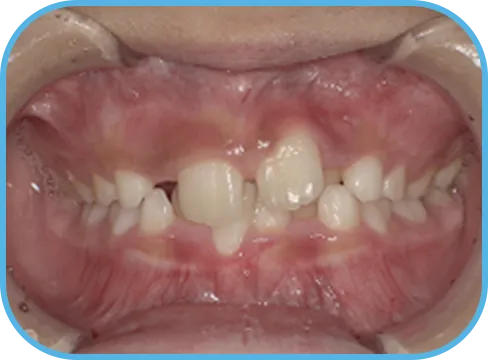 治療前正面からの歯の様子