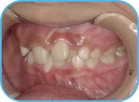 治療前左側からの歯の様子