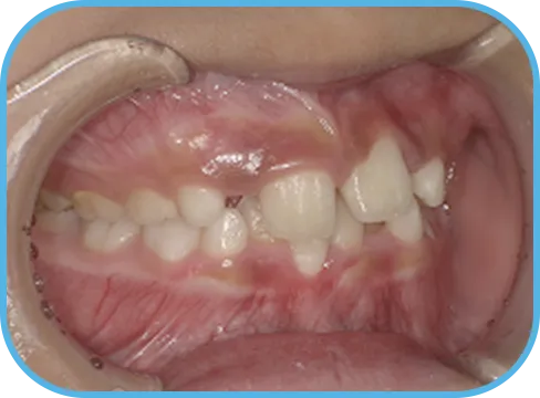 治療前右側からの歯の様子