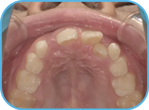 治療前上顎からの歯の様子