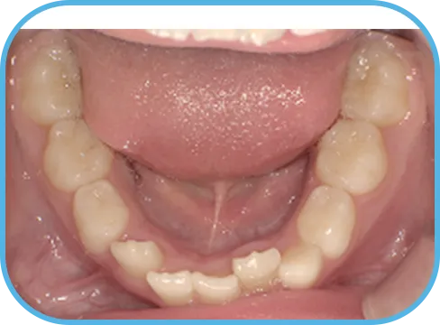 治療前下顎からの歯の様子