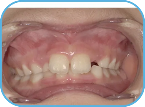 治療前正面からの歯の様子