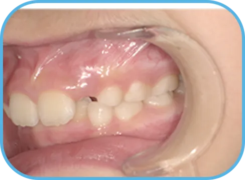 治療前左側からの歯の様子