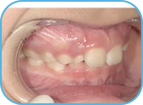 治療前右側からの歯の様子