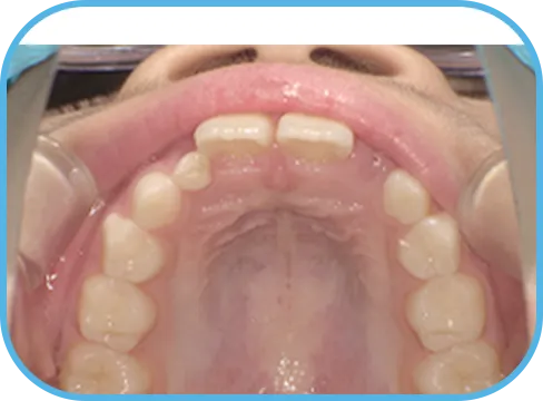 治療前上顎からの歯の様子