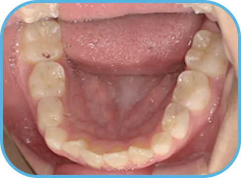 治療前下顎からの歯の様子