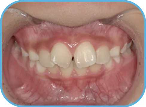 治療前正面からの歯の様子