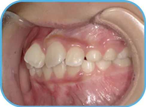 治療前左側からの歯の様子