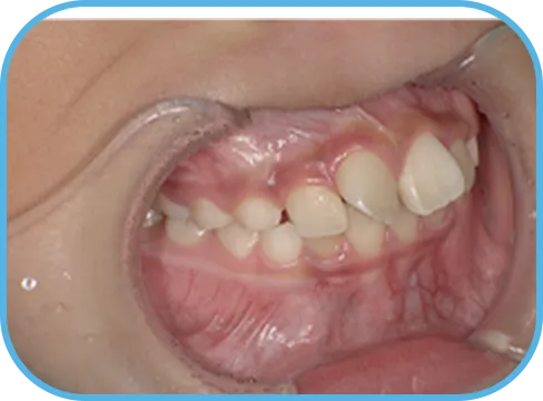 治療前右側からの歯の様子