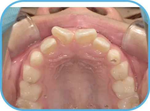 治療前上顎からの歯の様子
