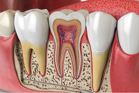 むし歯が歯の根まで到達した際に行う治療