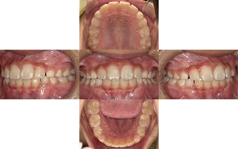 症例1-After-北名古屋みらい歯科