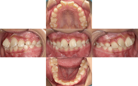 症例1-Before-北名古屋みらい歯科