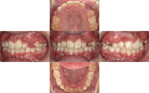 症例2-After-北名古屋みらい歯科