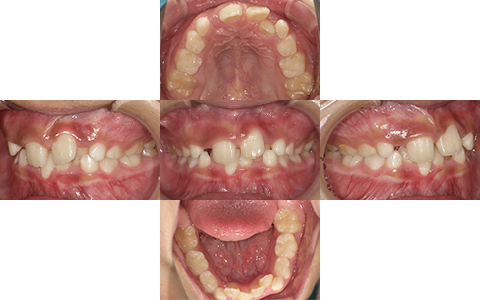 症例2-Before-北名古屋みらい歯科