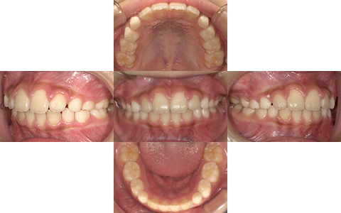 症例3-After-北名古屋みらい歯科