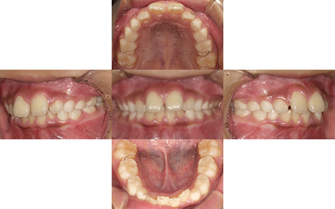 症例3-Before-北名古屋みらい歯科