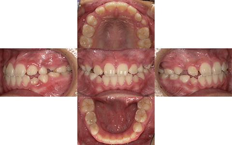 症例4-After-北名古屋みらい歯科