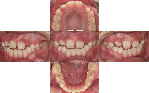 症例4-Before-北名古屋みらい歯科