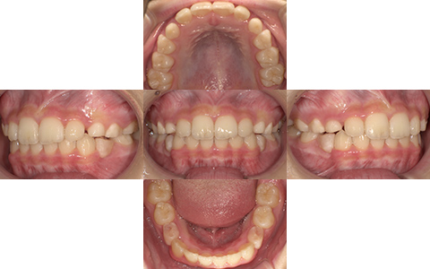 症例6-After-北名古屋みらい歯科